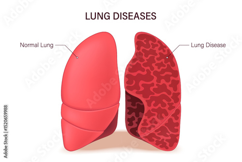 Lung diseases. Lungs anatomy. Normal lung and lung disease. Human respiratory system.