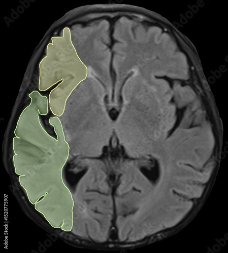 the distributions of cerebral blood vessels.