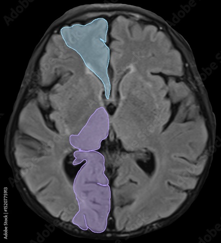 the distributions of cerebral blood vessels.