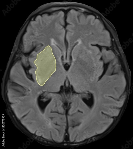 the distributions of cerebral blood vessels.