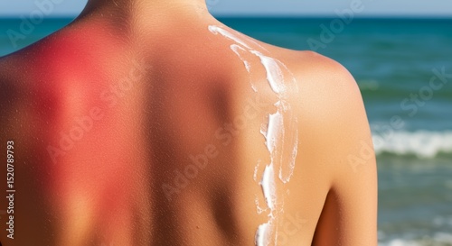 man back at the beach with clear SPF sunscreen demarcation. left side sunburned red, right side protected sunblock and pale