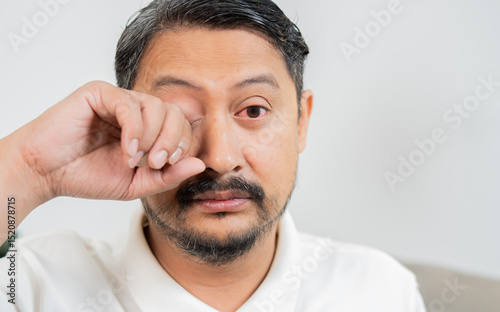 Close-up Asian man suffering from irritated eye with copy space, concept of optical health care, eye care and allergic