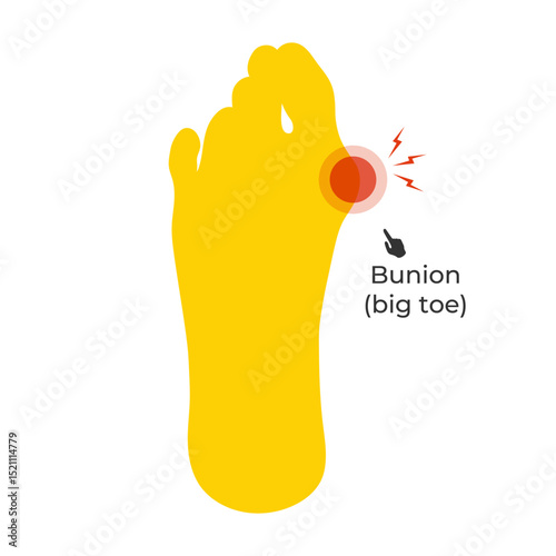 Silhouette of a foot sole with a Hallux valgus deformation. Painful bunion of a big toe. Vector illustration