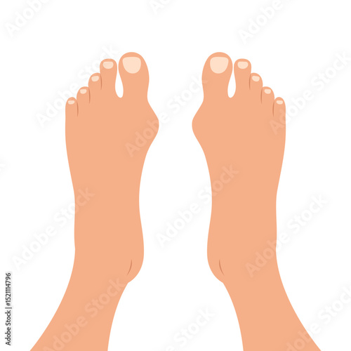 Human feet with deformities of big toe joint. Top view of bare feet with Hallux valgus deformation. Vector illustration