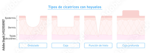 Tipos de cicatrices de acné con hundimiento
