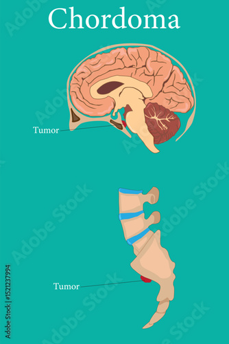 Medical illustration showing chordoma tumors at skull base and sacrum, human anatomy diagram