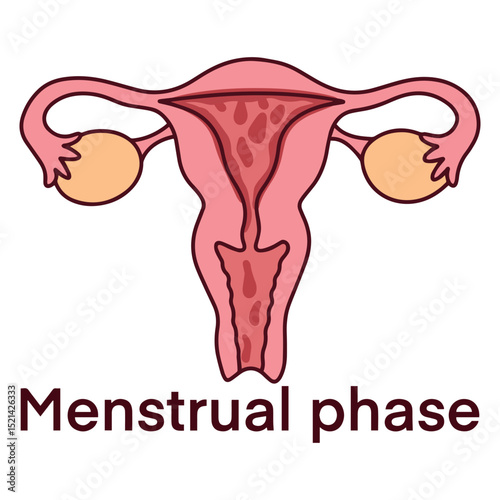 Medical illustration of uterus during menstrual phase. Shows blood shedding from endometrial lining, used in gynecology education and menstrual health awareness