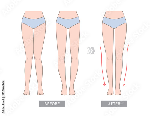 Knock knees, bow legs and normal legs. Knee valgus deformities. Healthy joint, knock-knee and Bow-leggedness. Corrective surgery