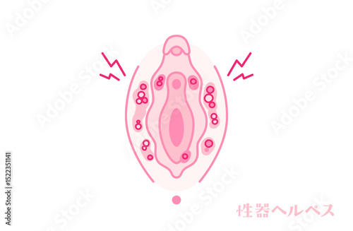 性器ヘルペスのある女性器（外陰部）
