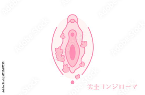 尖圭コンジローマのある女性器（外陰部）