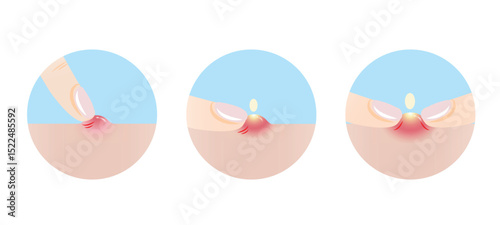The icon set of pick at pimple, popping and squeezing acne with fingers on skin illustration. It is not good to squeeze pimples, can cause scarring and infection. Skin care and beauty concept.