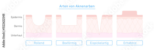 Arten von Aknenarben mit Hautquerschnitt – anschauliche Illustration