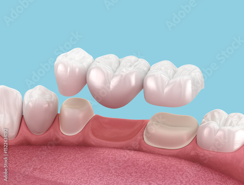 Dental bridge of 3 teeth over molar and premolar. Medically accurate 3D illustration of human teeth treatment