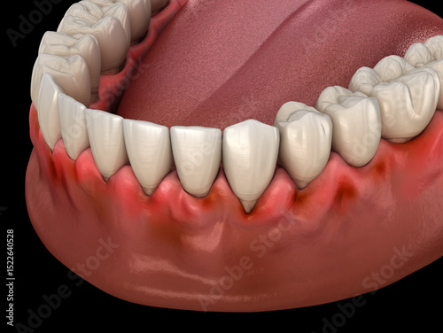 Photos Gingivitis inflammation of the gums. Dental 3D illustration