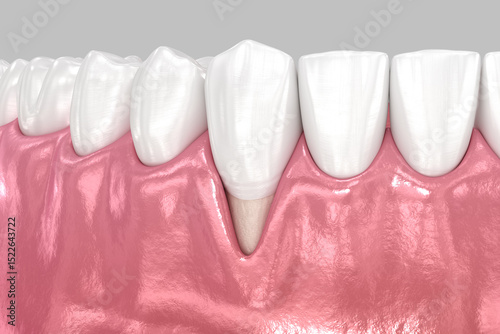 Gum Recession: Soft tissue moving down. Dental 3D illustration