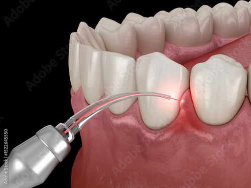 Gum correction surgery with laser.  Dental 3D illustration