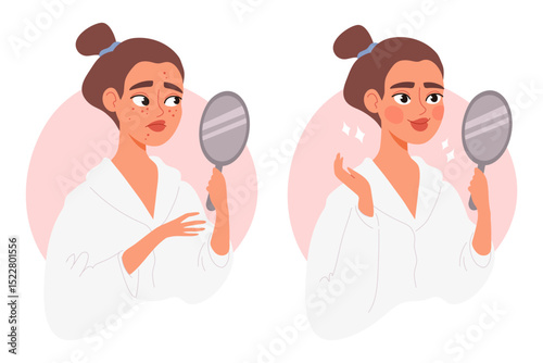 Young woman looking in mirror before and after skin treatment. Facial acne vs. clear glowing skin. Concept of skincare, beauty transformation, and cosmetic results