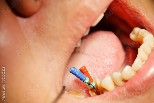 Foto A patient undergoing root canal treatment on a molar tooth that has two roots