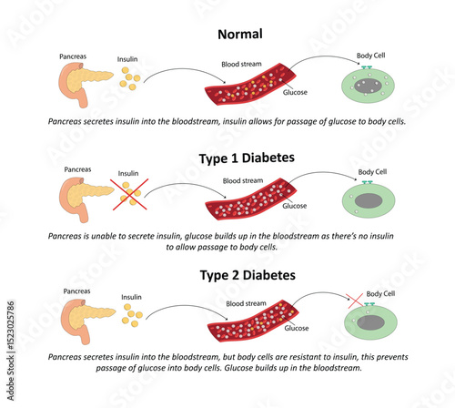 Diabetes mellitus type 1 and type 2 vector illustration