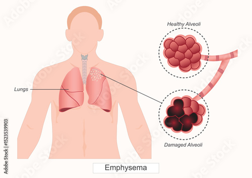 Emphysema is a long-term lung condition that causes shortness of breath.