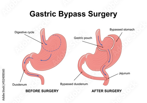 Gastric bypass gastroplasty stomach operation. Human organs before and after surgery. Obesity problem, weight loss procedure. Abdomen laparoscopy medical poster. Overweight problem vector illustratio