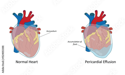 Pericardial effusion vector illustration