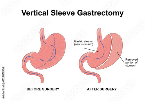 Vertical sleeve gastrectomy. Distended stomach surgery, gastroenterology operation. Weight loss procedure, limiting the size of the stomach. Flat vector illustration