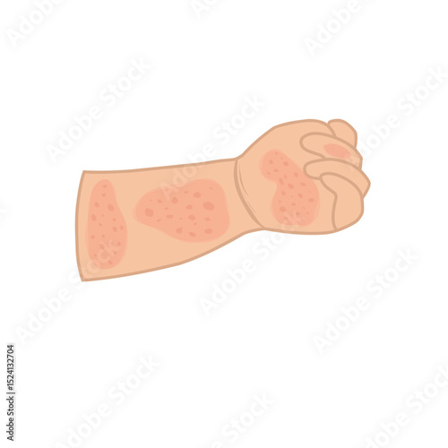 Illustration of a baby's hand with allergies. Cartoon illustration of a baby's hand 
