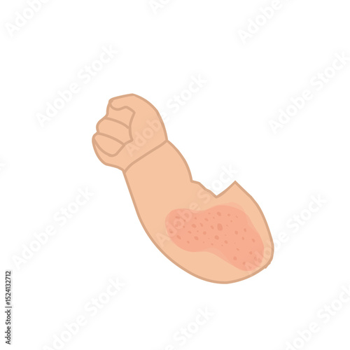 Illustration of a baby's hand with allergies. Cartoon illustration of a baby's hand 
