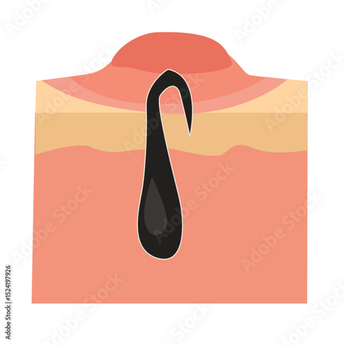 hair growing on the skin.Ingrown hair occurs when a hair curls back or grows sideways into the skin, 