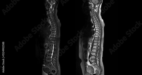 MRI Screening whole spine  sagittal T2  FS showing  spine compress spinal cord ( Myelopathy )