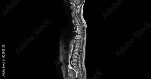 MRI Screening whole spine  sagittal T2  FS showing  spine compress spinal cord ( Myelopathy )