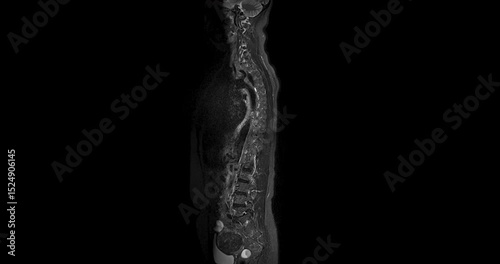 MRI Screening whole spine  sagittal T2  FS showing  spine compress spinal cord ( Myelopathy )