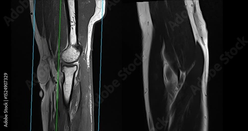 MRI elbow joint  for Evaluation of the elbow by magnetic resonance imaging (MRI) is To facilitate accurate diagnosis.