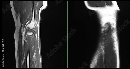 MRI elbow joint  for Evaluation of the elbow by magnetic resonance imaging (MRI) is To facilitate accurate diagnosis.