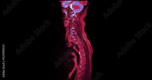 MRI C-spine or magnetic resonance image of cervical spine Coronal and sagittal T2W view for diagnosis spondylosis and compression fracture.