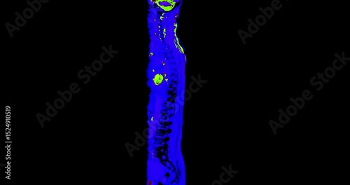 MRI Screening whole spine  sagittal T2  FS showing  spine compress spinal cord ( Myelopathy )