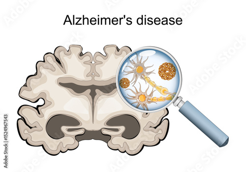 Alzheimers disease. microscopic view of neurons showing neurofibrillary tangles and amyloid plaques