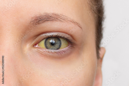 Yellow eye of a young woman close-up. Symptom of jaundice, hepatitis. Liver disease, high bilirubin, Gilbert's syndrome photo