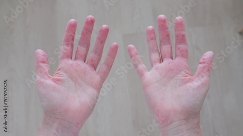 Understanding hand rashes from chickenpox to allergic contact dermatitis