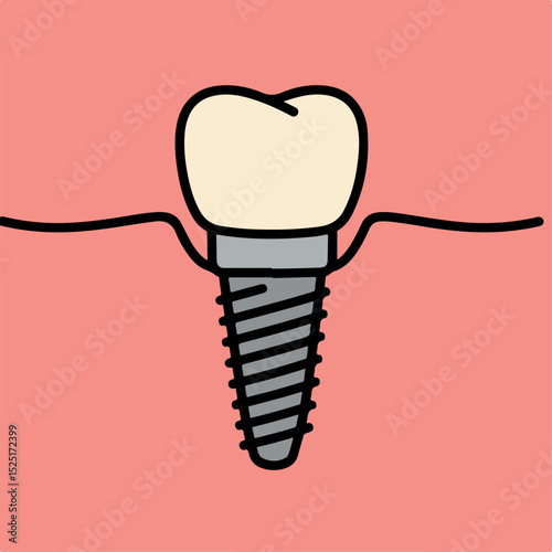 Dental implant illustration showing a single tooth with a titanium screw.  Detailed image of a dental implant for educational purposes or patient brochures.