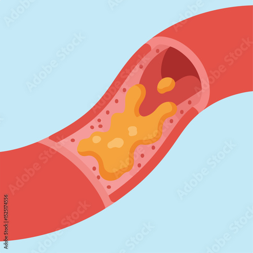 Cross section of artery with cholesterol plaque buildup. Detailed illustration shows artery blockage and cholesterol deposits.  Medical illustration for educational materials, patient brochures,