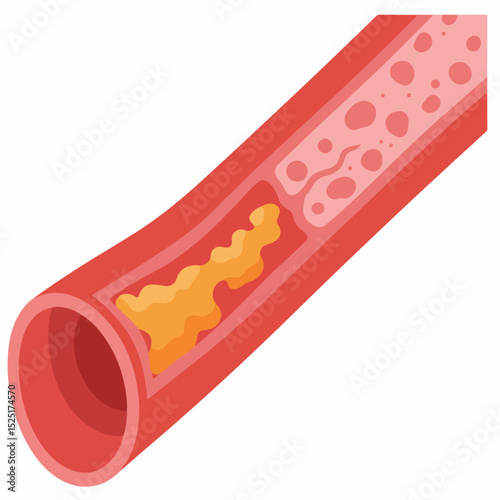 Human artery with cholesterol plaque buildup. Cross section of artery showing atherosclerosis. Detailed illustration of artery blockage for medical education.