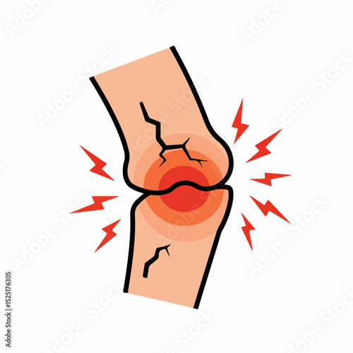 Injured knee joint illustration with cracks and red inflammation. This medical illustration shows knee pain and bone damage.  Graphic depicts sharp pain,