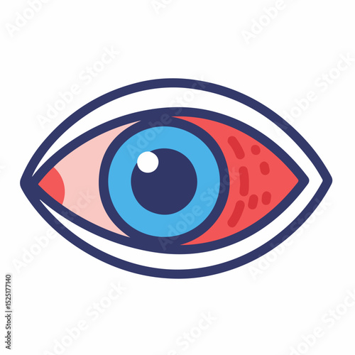 Red eye illustration. Detailed anatomy shows blood vessels and iris.  Inflammatory process depicted for ophthalmology educational materials.