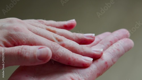 Examining hand rashes: from eczema to chickenpox symptoms