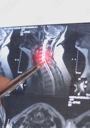 Vertical Mri scan of cervical spine hernia. Medical x-ray examining.