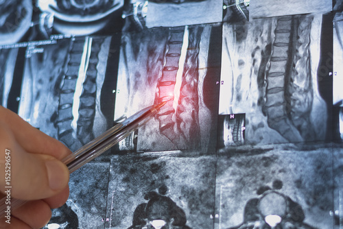 Mri scan of cervical spine hernia. Medical x-ray examining.