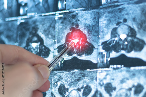 Examination mri of inside herniated vertebral disk in spine, close up x-ray view.