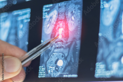 Examination mri of inside herniated vertebral disk in spine, close up x-ray view.